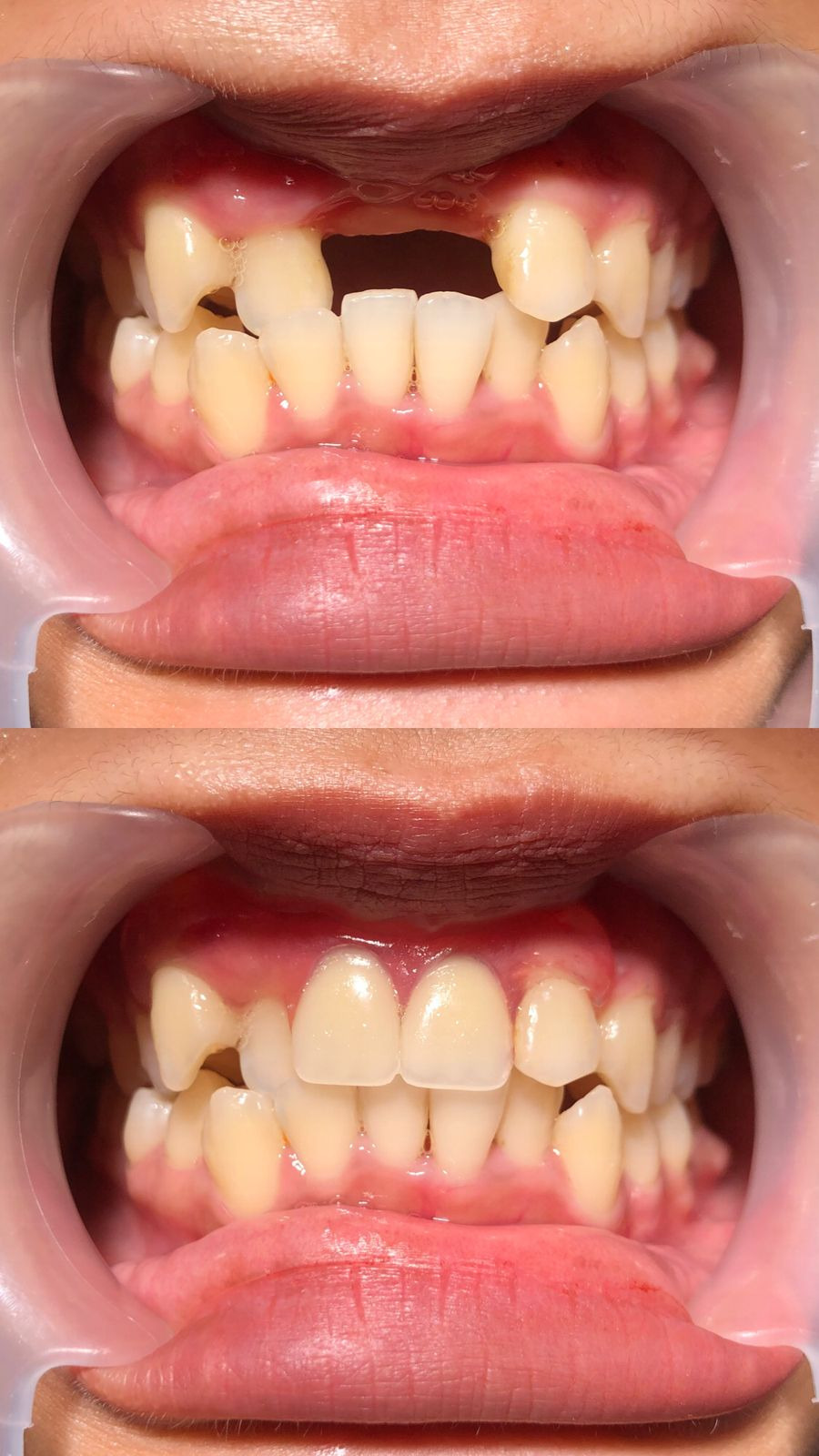 Dokter gigi terbagus di Solo Mengembalikan Gigi yang Utuh Dengan Gigi Tiruan Demi Kesehatan gigi dan Kehidupan Sehari-Hari : Edukasi Gigi Tiruan