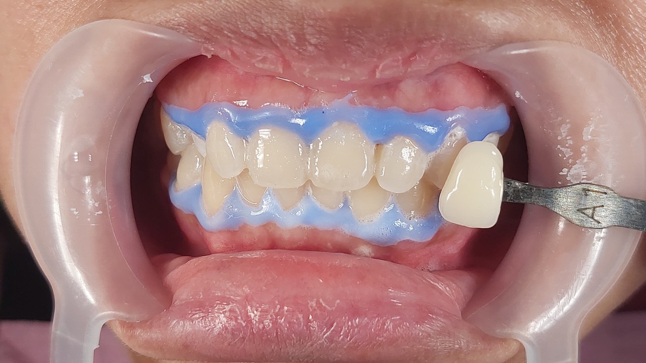 Proses dan Perawatan Setelah Pemasangan Behel Gigi