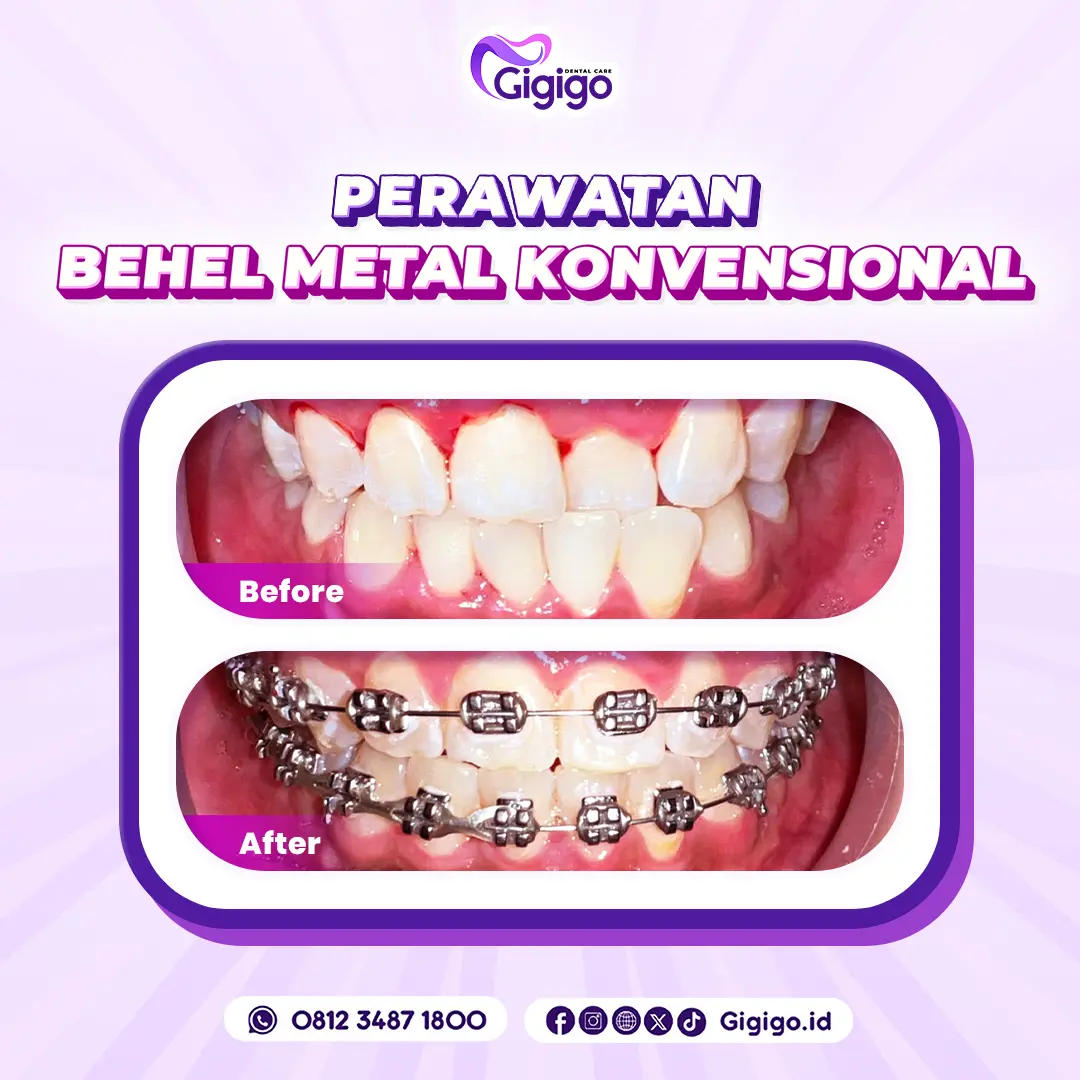 Bf af behel metal konvensional