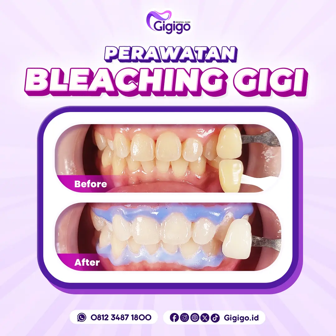 Bf af bleaching gigi
