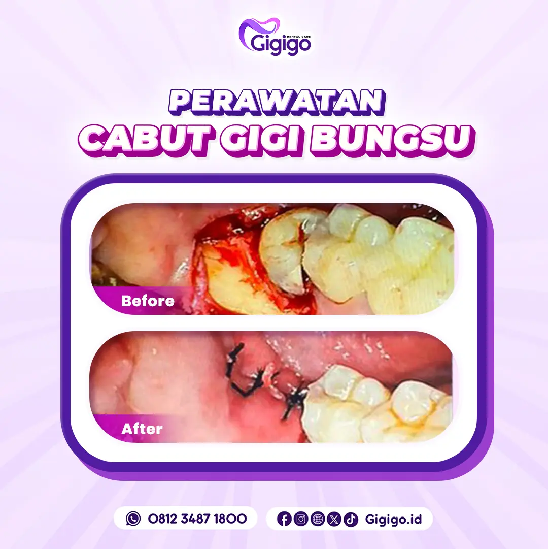 BF AF CABUT GIGI BUNGSU