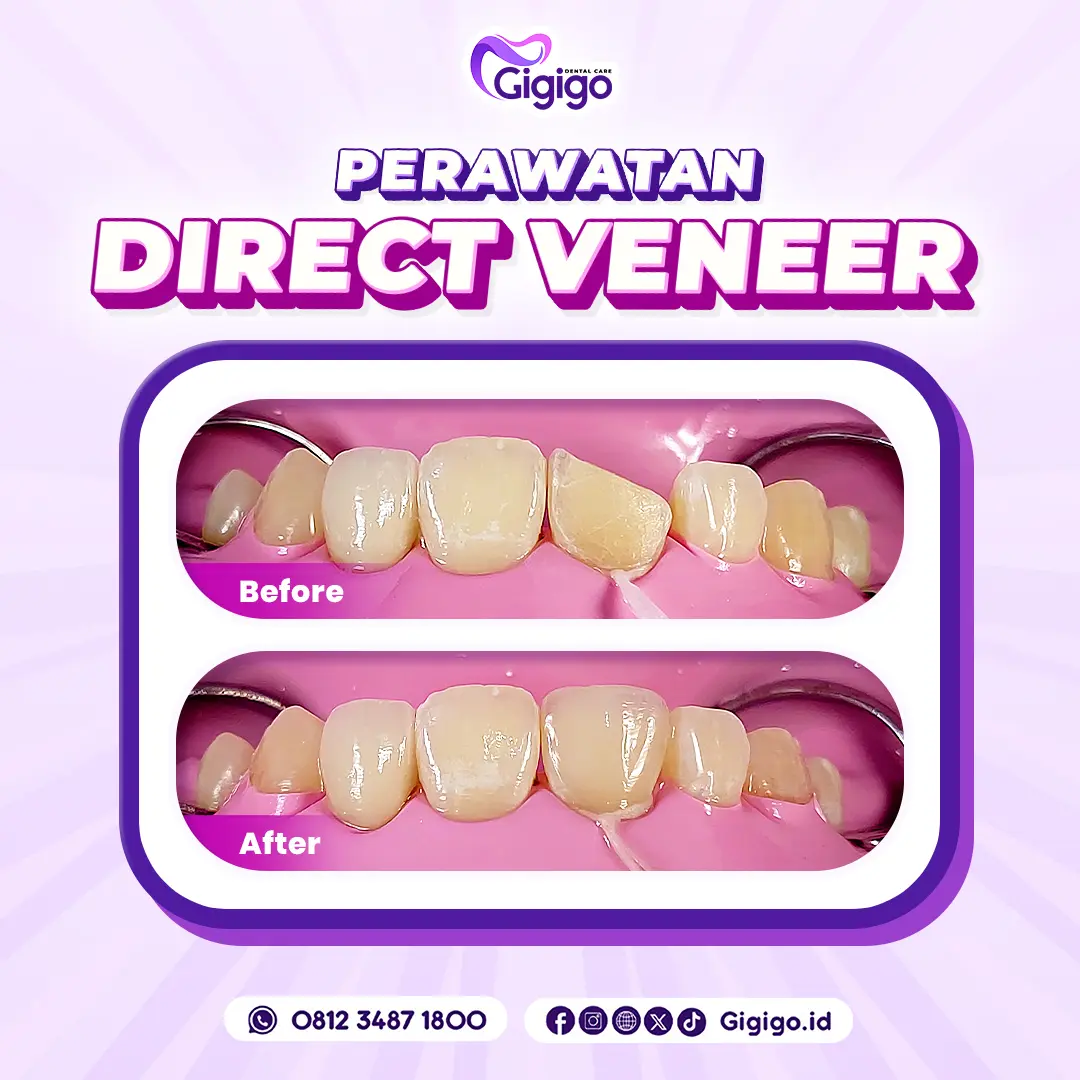 Bf af direct veneer