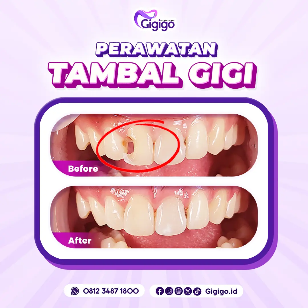 Bf af tambal gigi