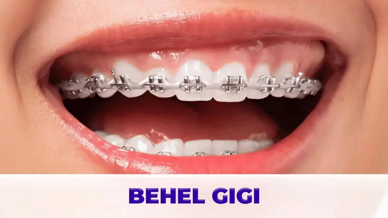 Layanan Behel Gigi Gigio