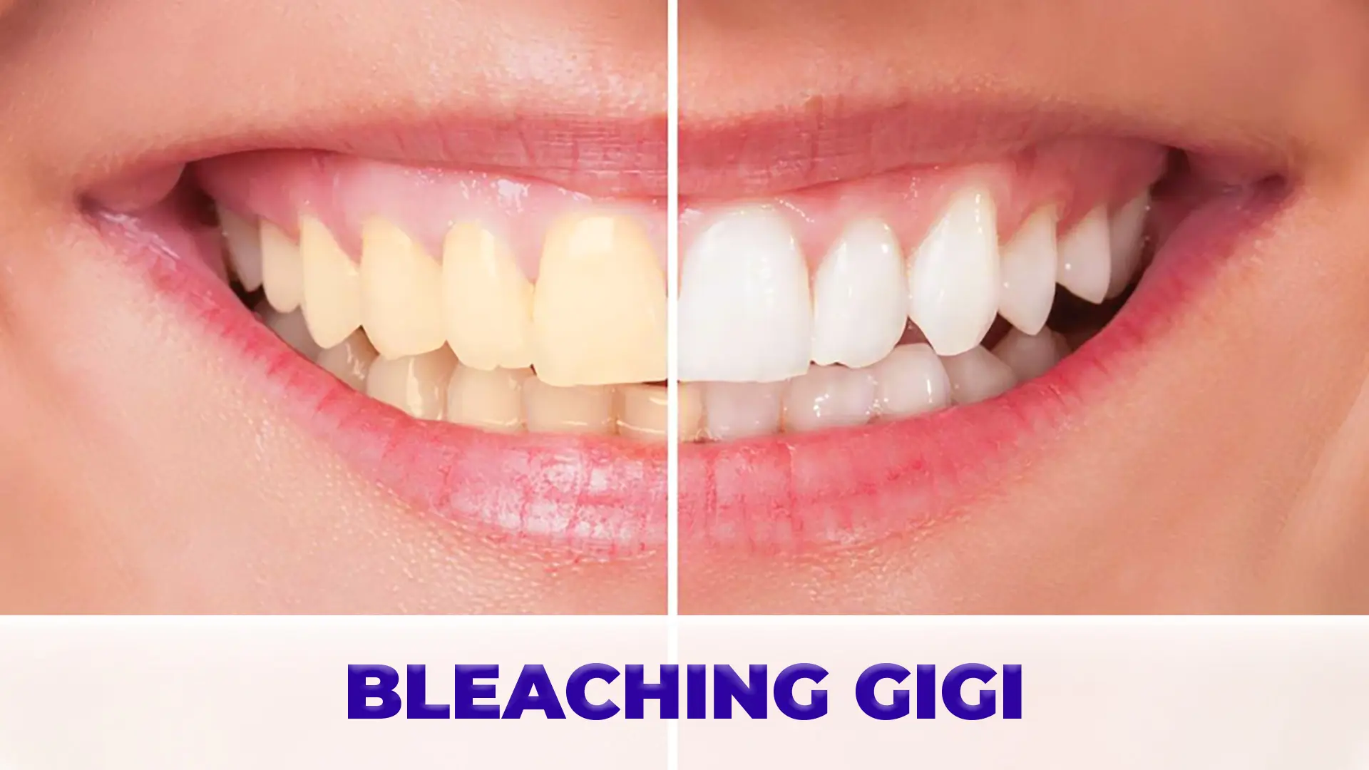 Foto Perawatan Bleaching Gigi (1)