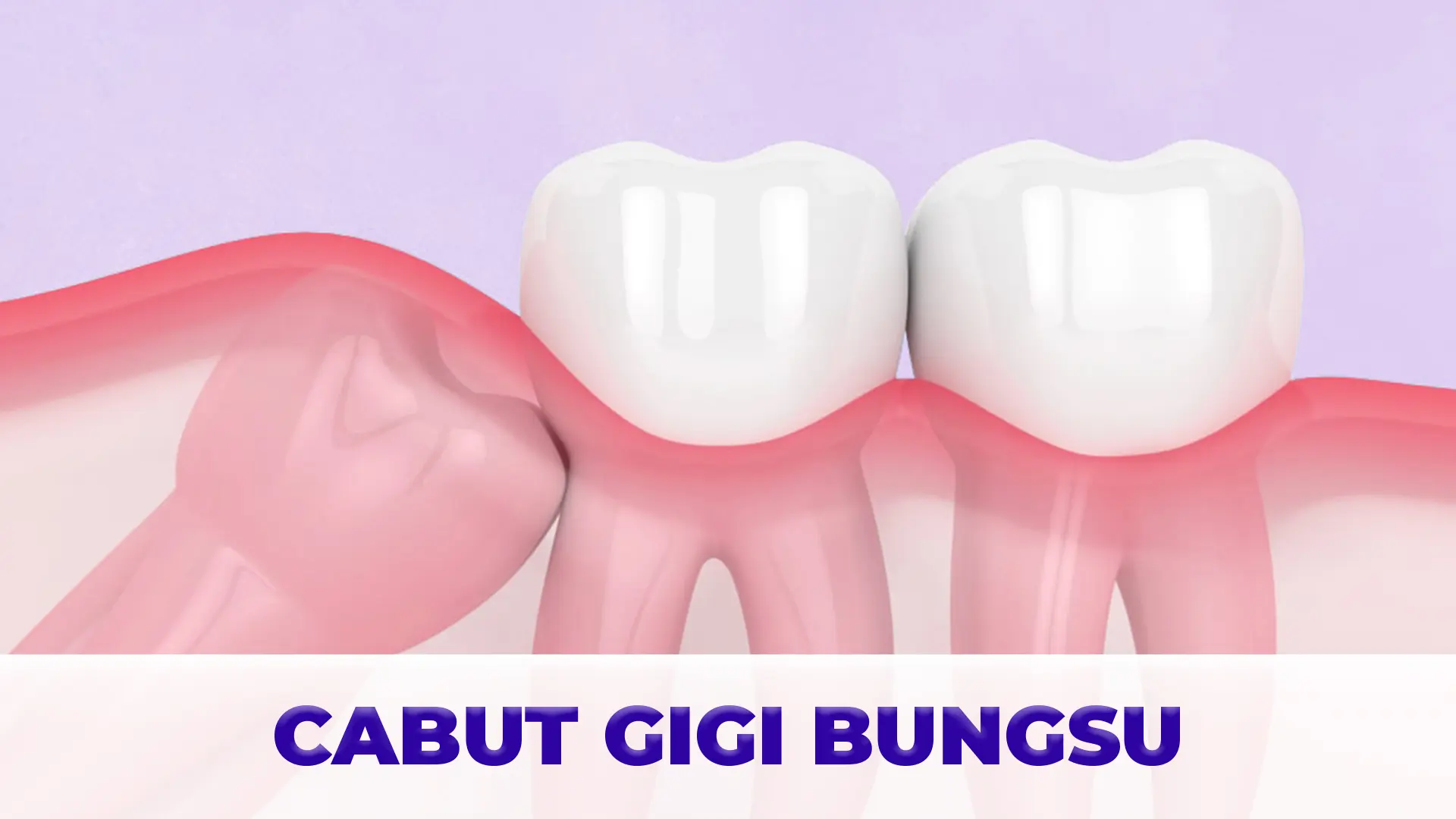 Foto Perawatan Cabut Gigi Bungsu (1)