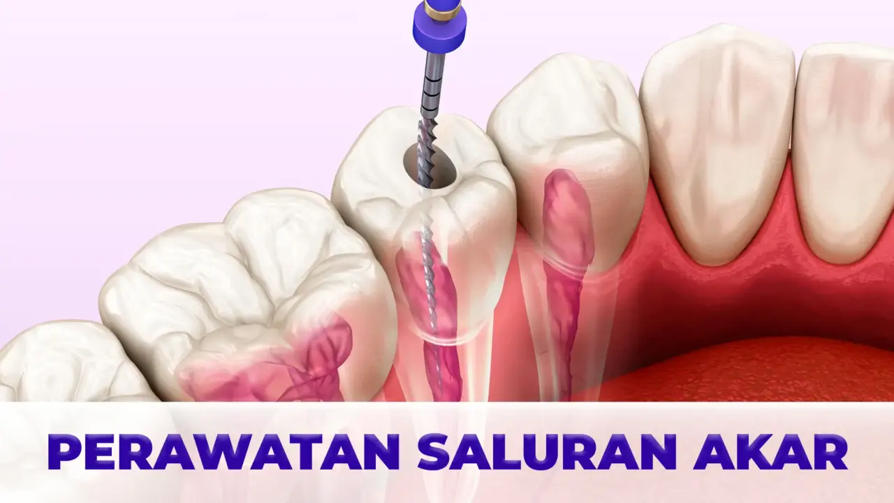 Layanan Perawatan Saluran Akar Gigio