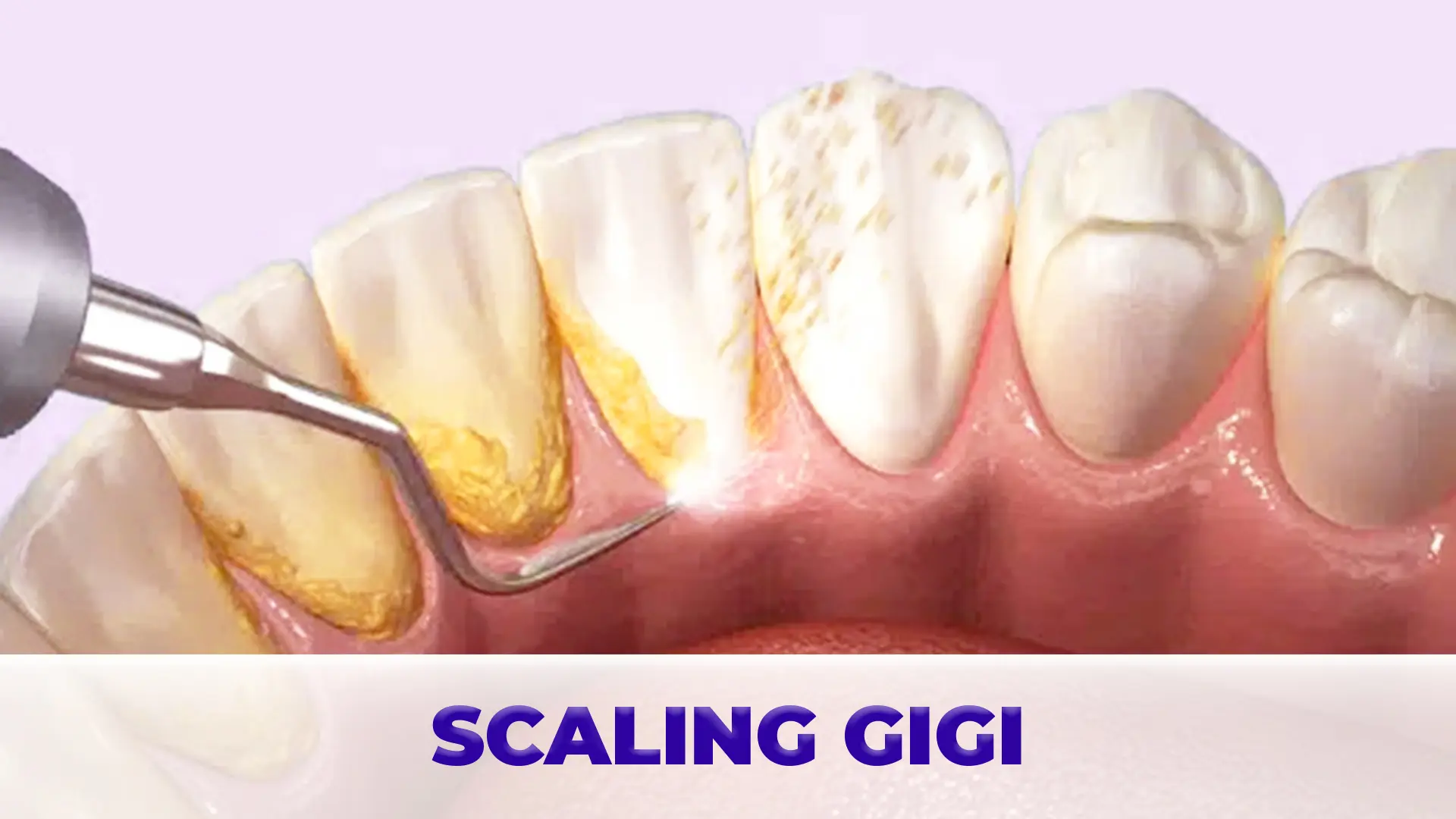 Foto Perawatan Scaling Gigi (1)