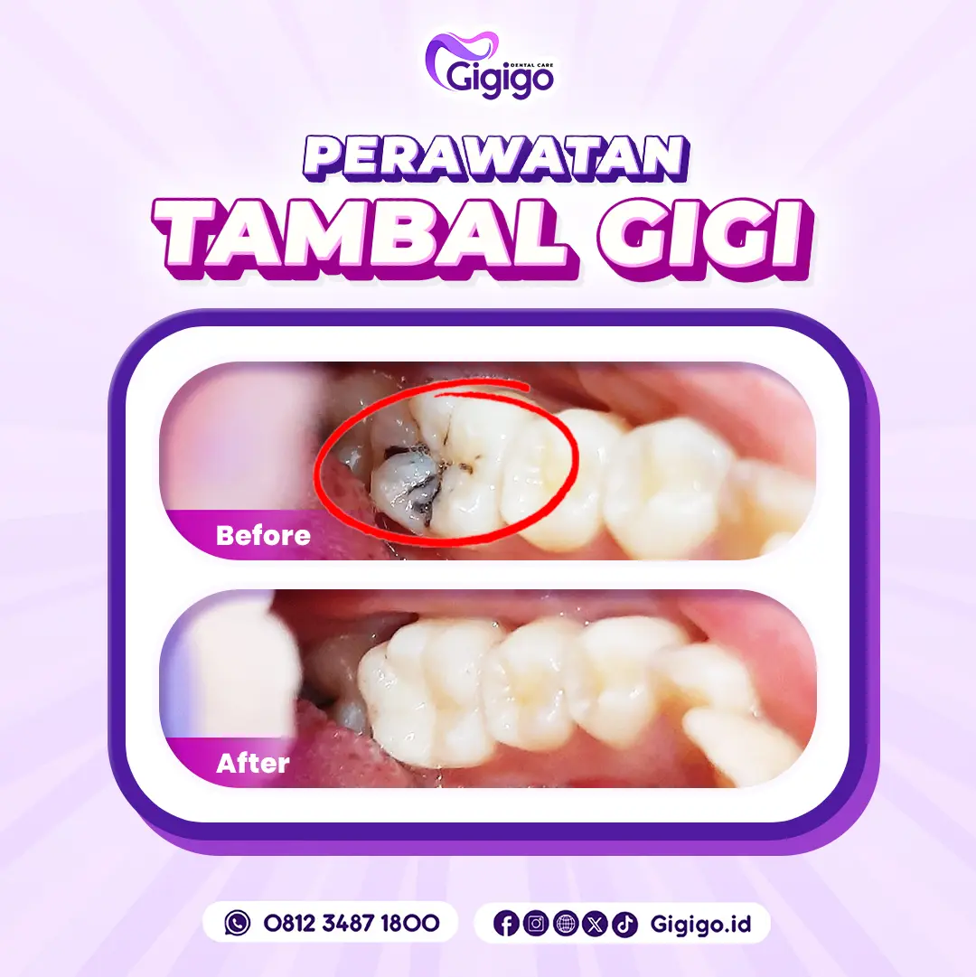 Web before after tambal a