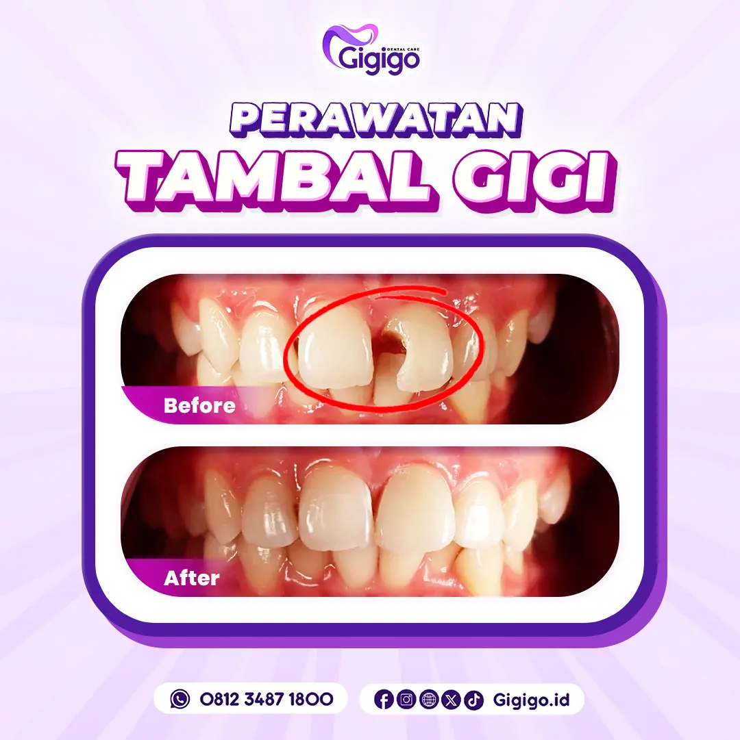 Web before after tambal b