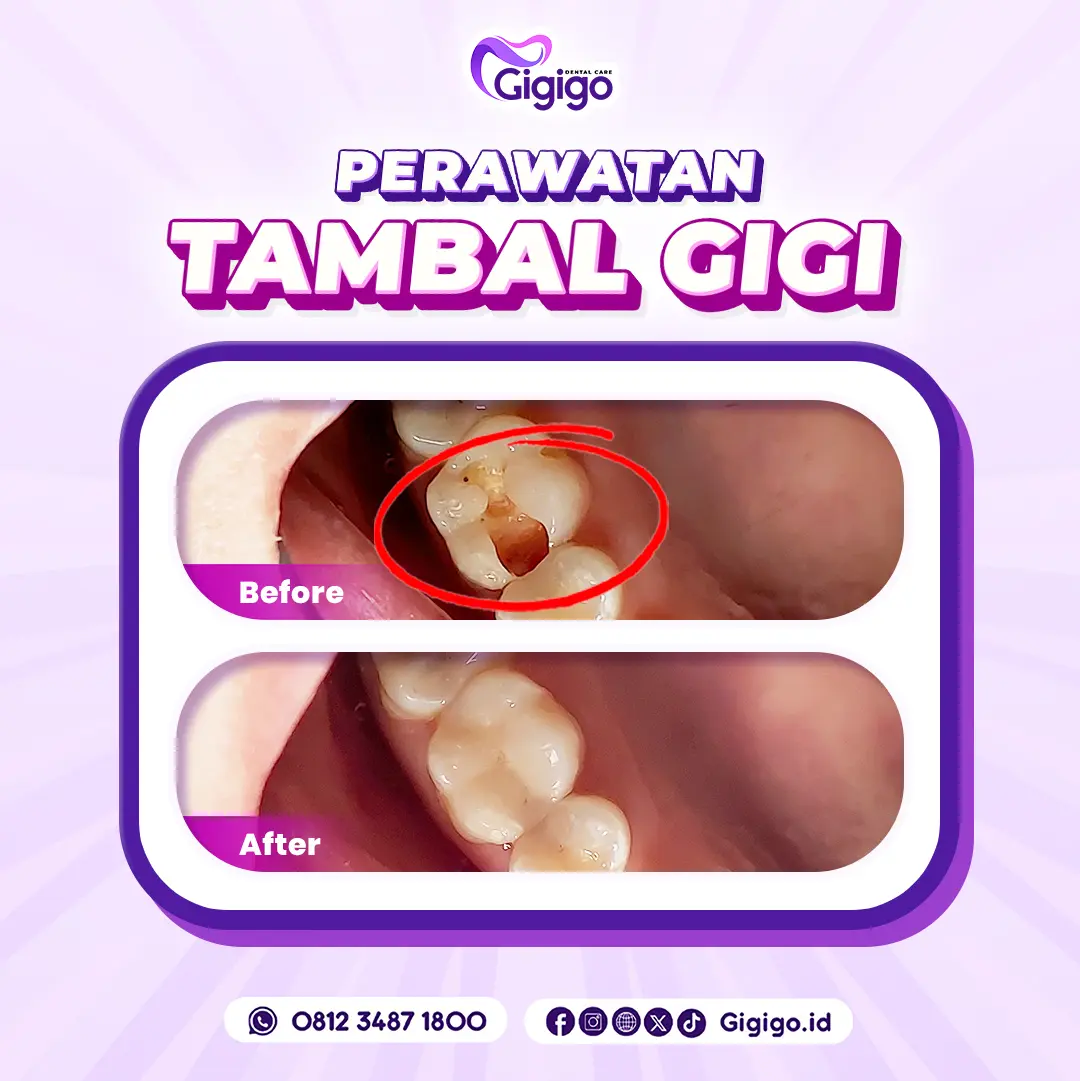 Web before after tambal c
