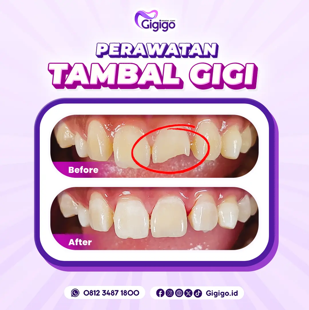 Web before after tambal d