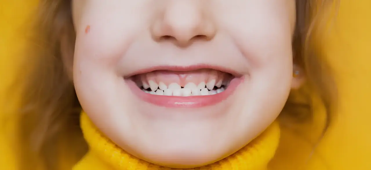 Kondisi Gigi Perlu Perawatan Malokusi